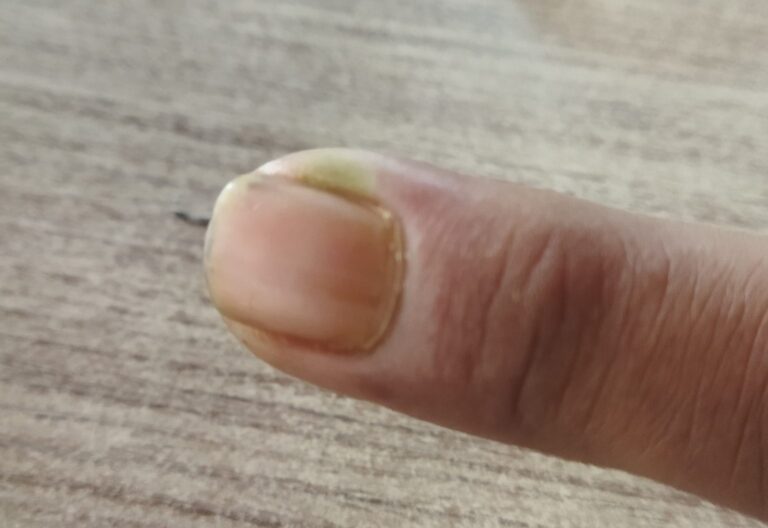Sering Potong Kuku Terlalu Dalam? Waspada Cantengan